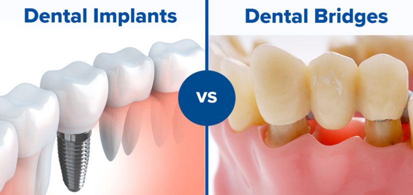 dental-bridges-vs-dental-implants